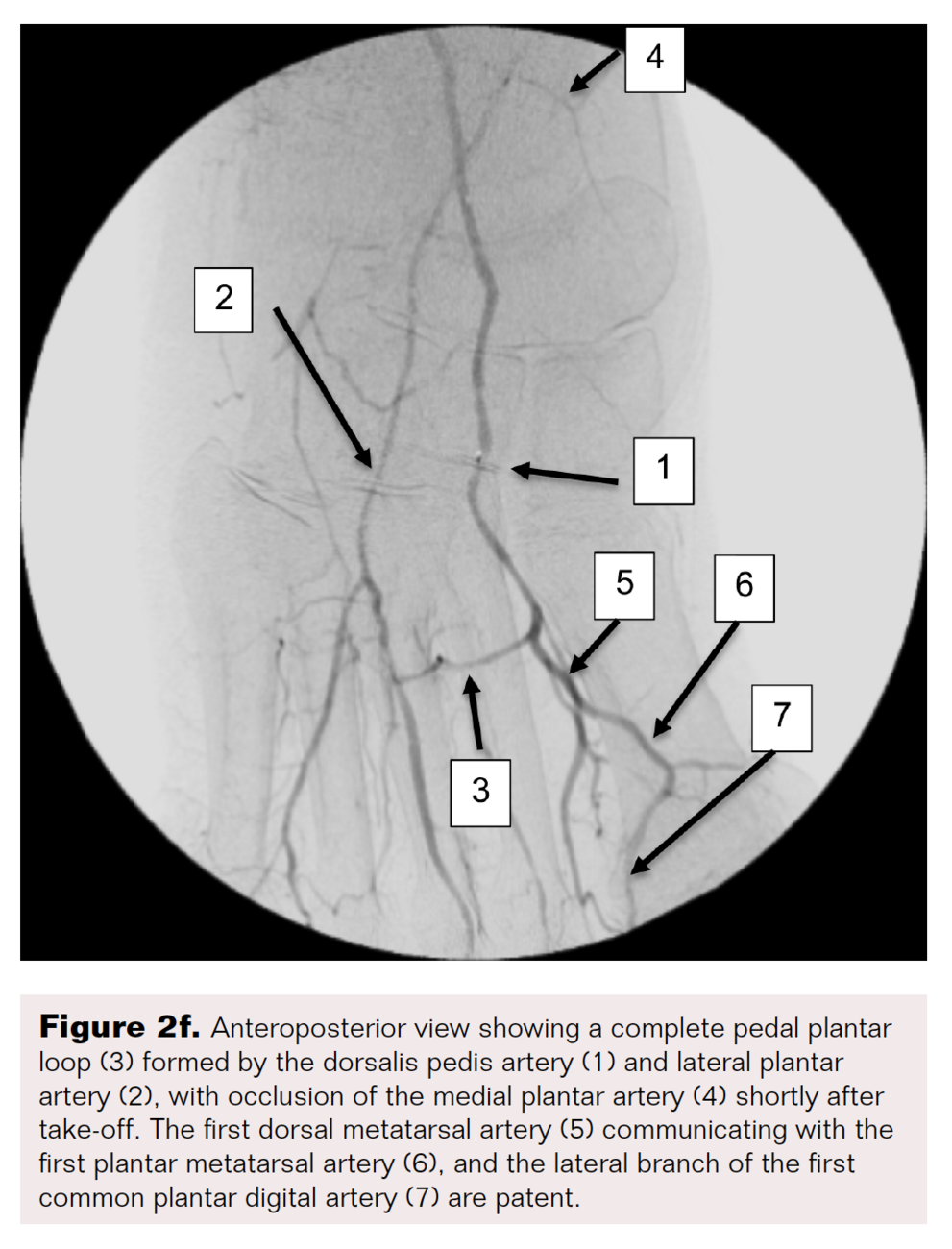 PedalPlantar Loop in Lower Extremity Angiography VDM